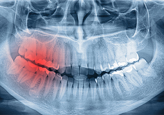 Dental Pain